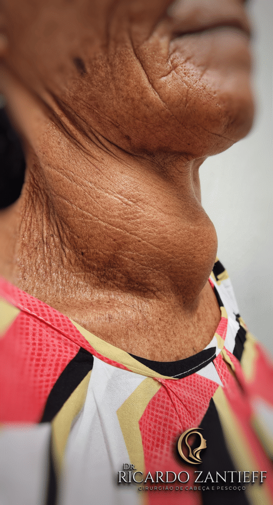 Imagem de uma mulher de meia idade com a tireoide crescida