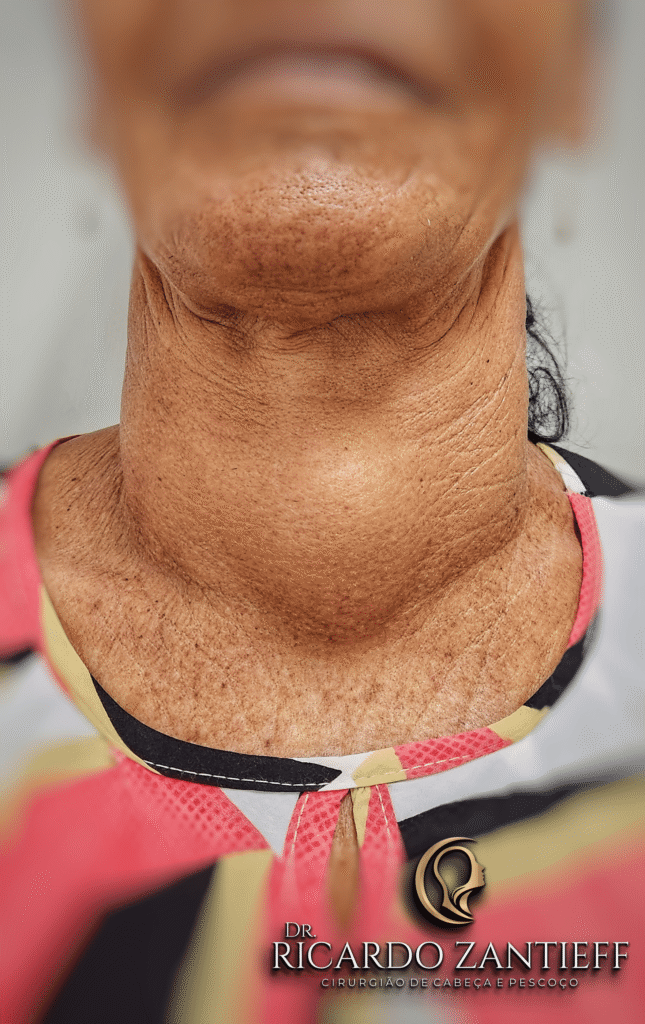 Paciente apresentando aumento da glândula tireoide - Visão Frontal