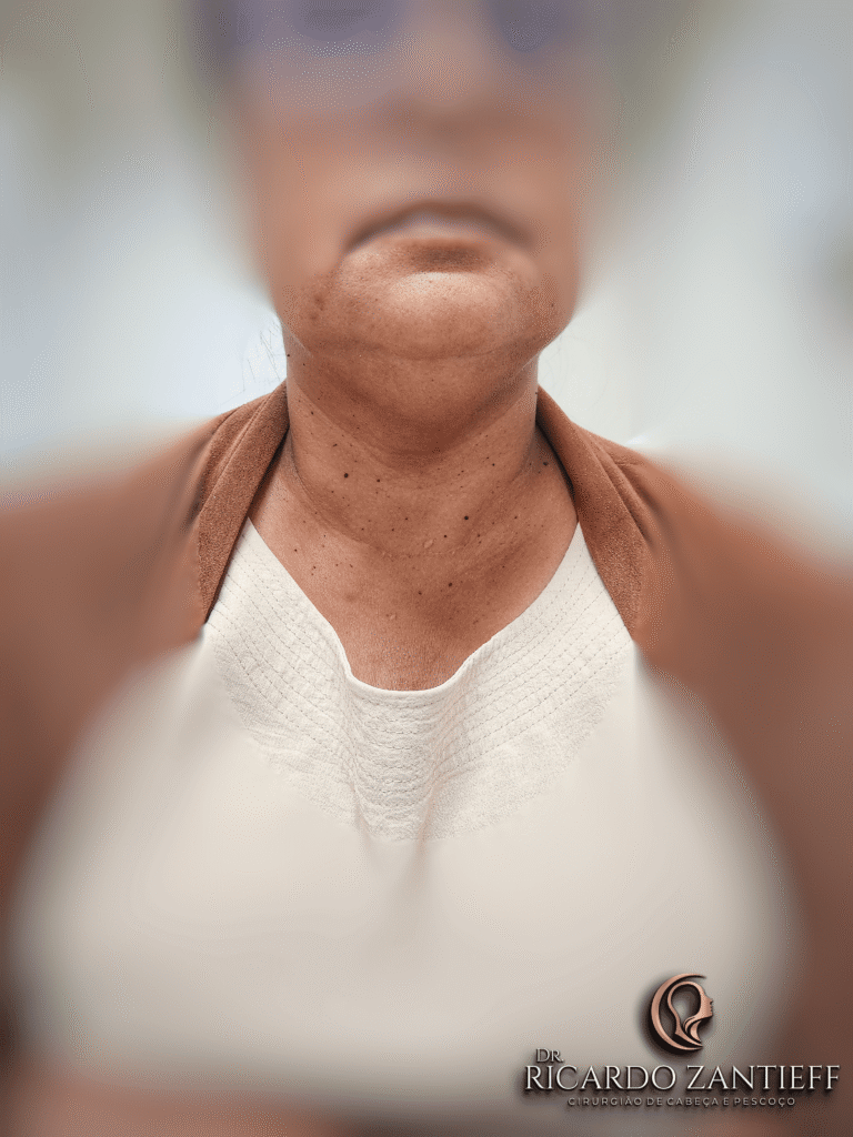 Cicatriz da cirurgia