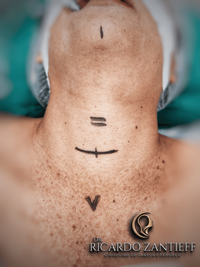 Marcações no pescoço do paciente