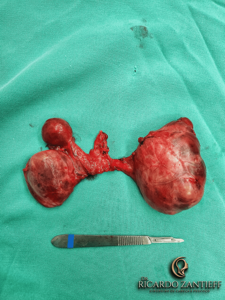 Glândula tireoide retirada durante cirurgia