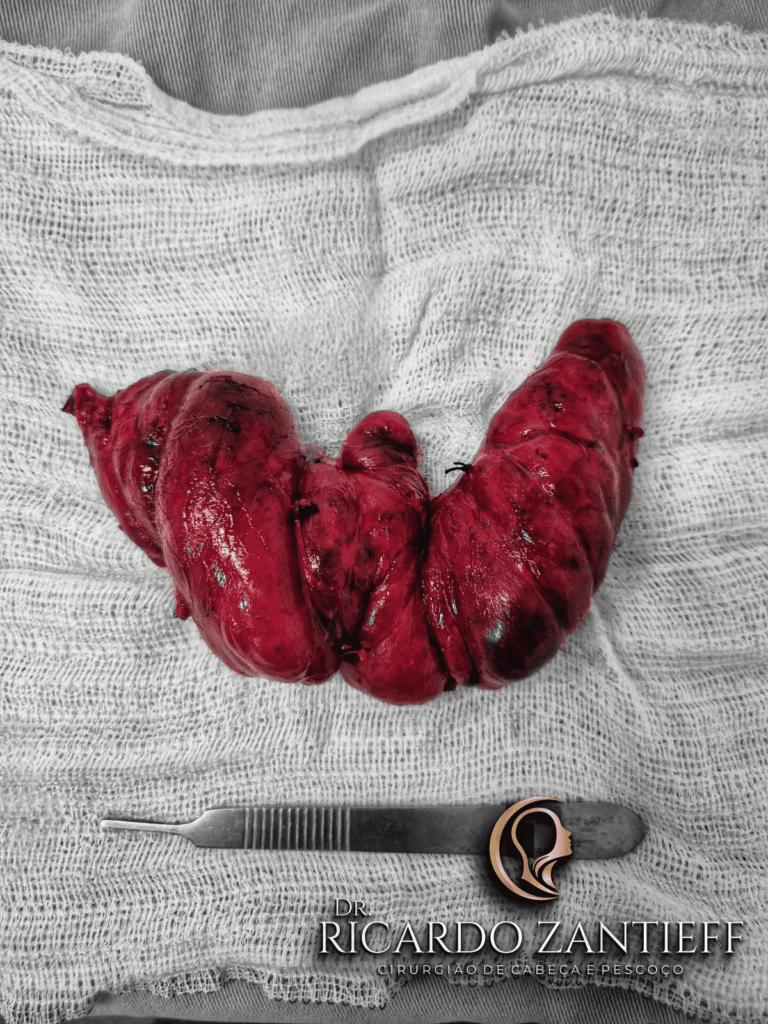 Glândula tireoide retirada durante cirurgia