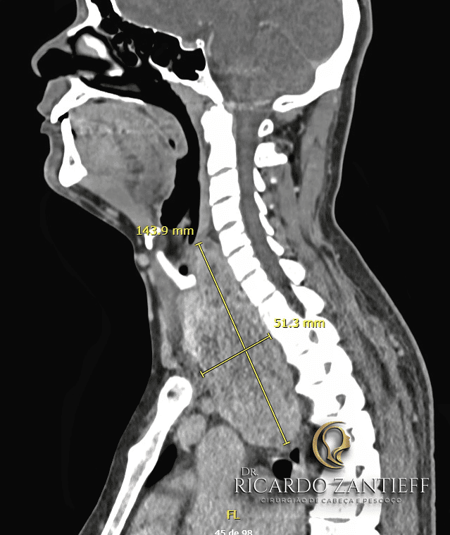 tomografia de paciente com bócio