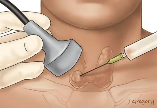 punção aspirativa por agulha fina (PAAF)
