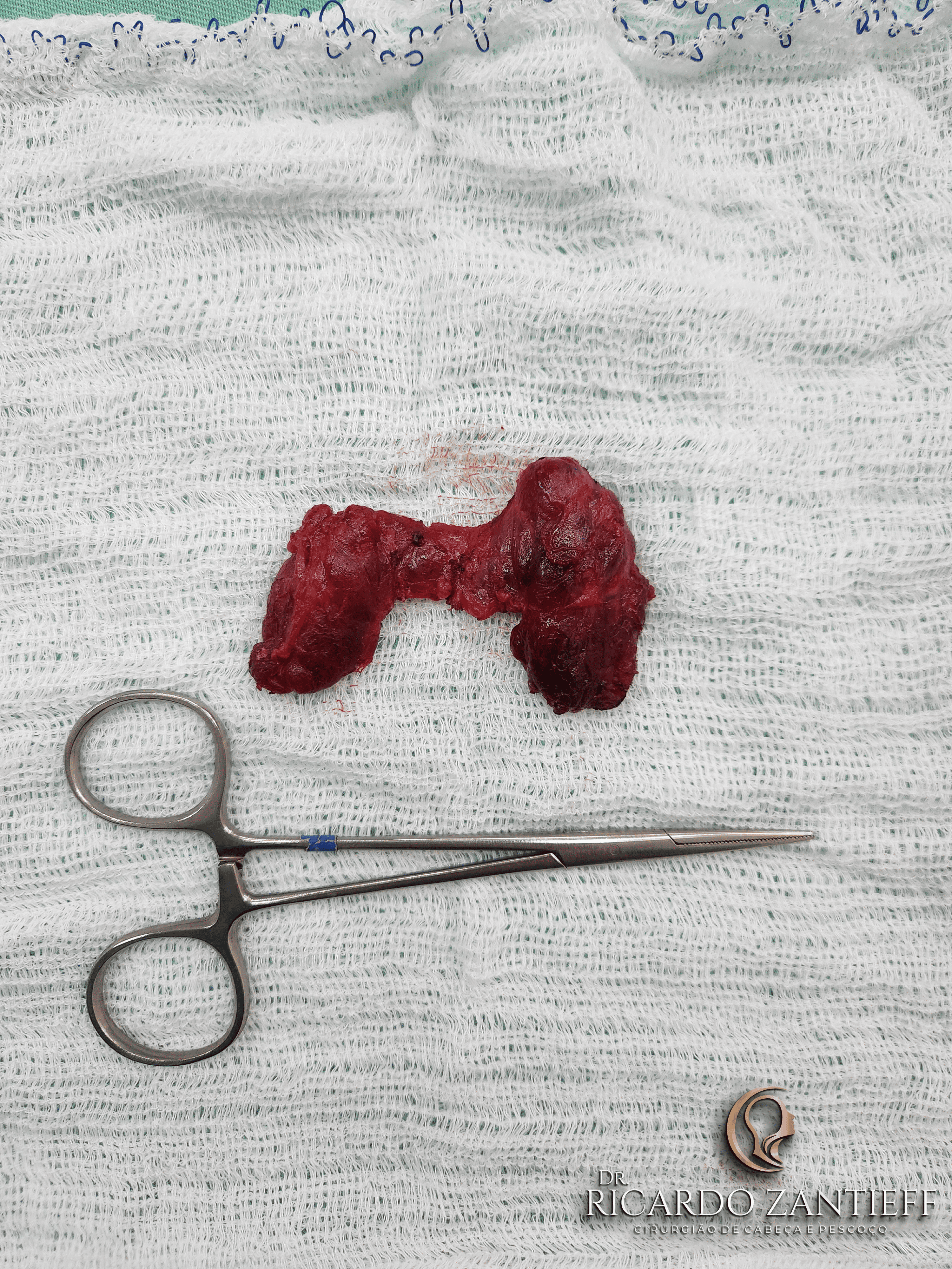 Tireoide retirada em cirurgia