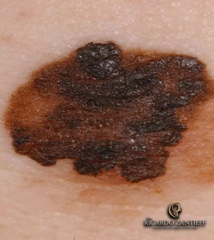 Melanoma