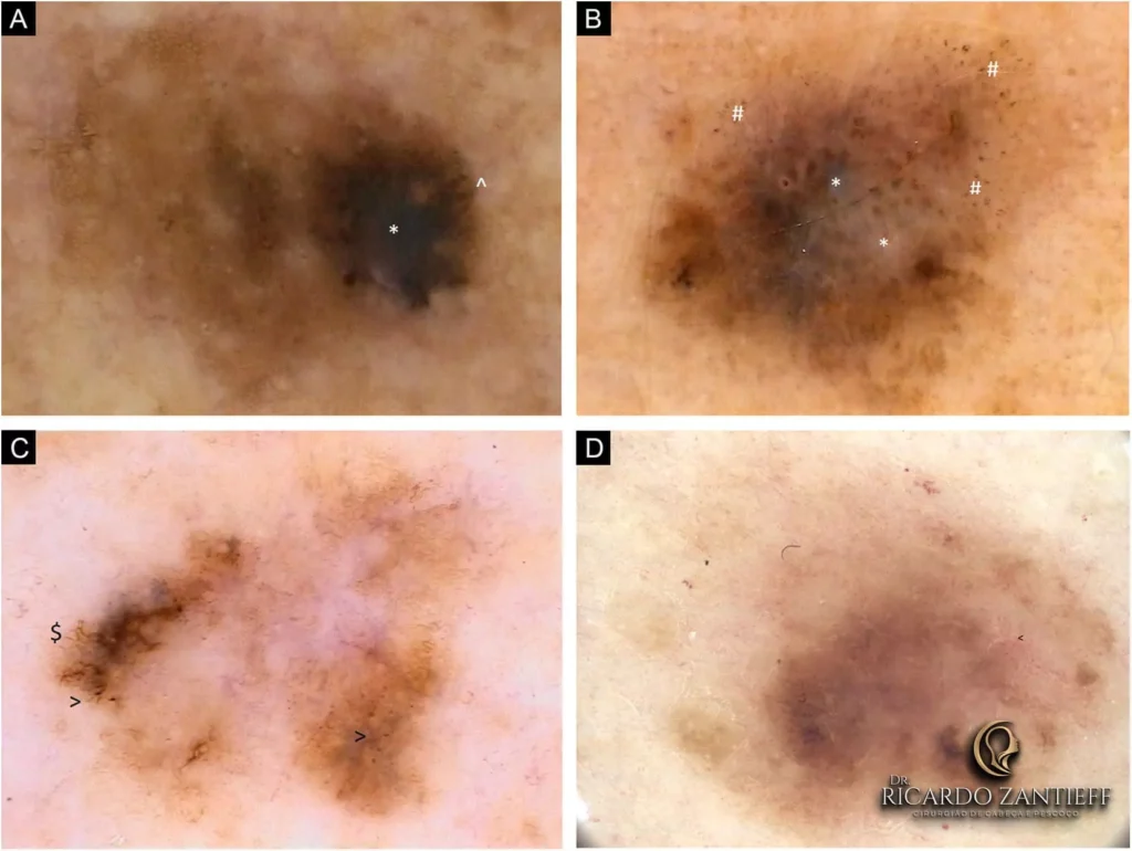 Melanoma