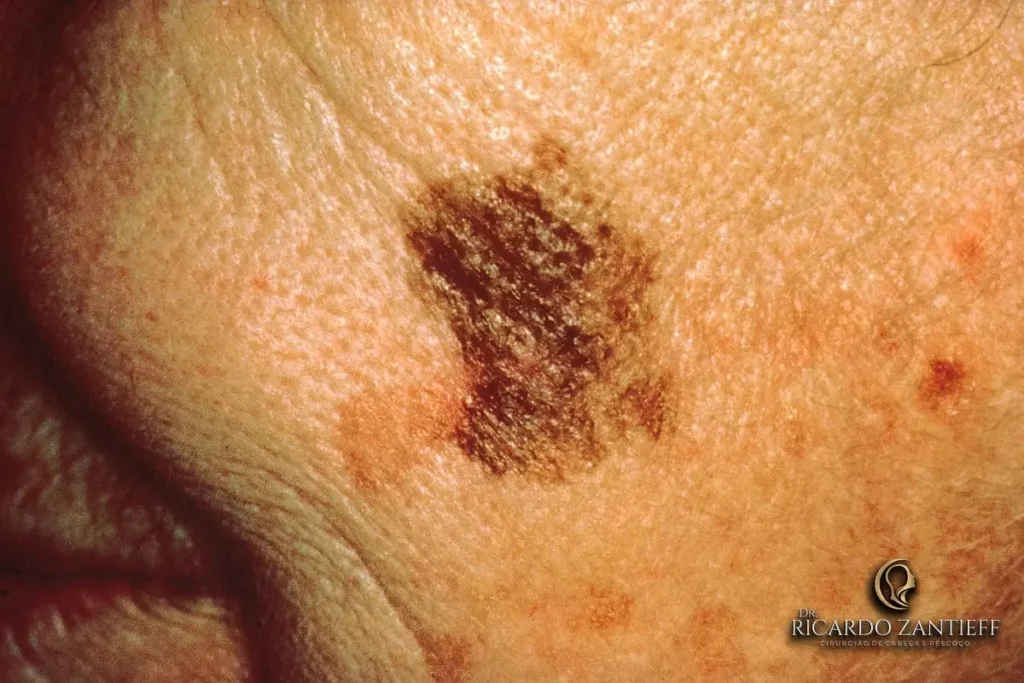 Melanoma