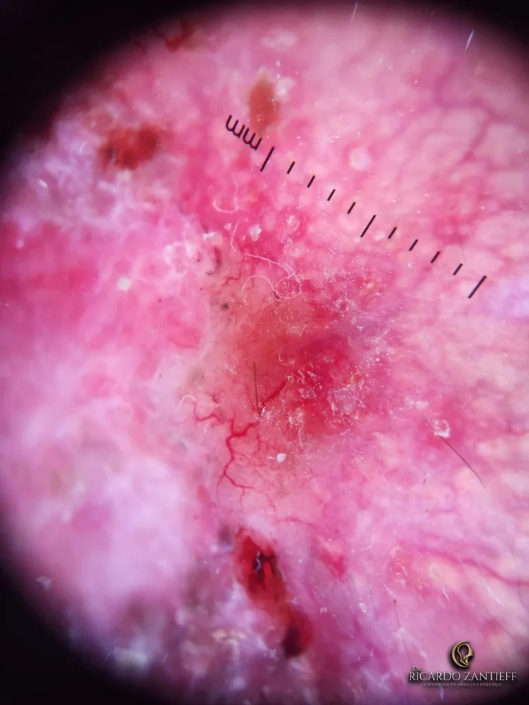 Imagem de uma dermatoscopia