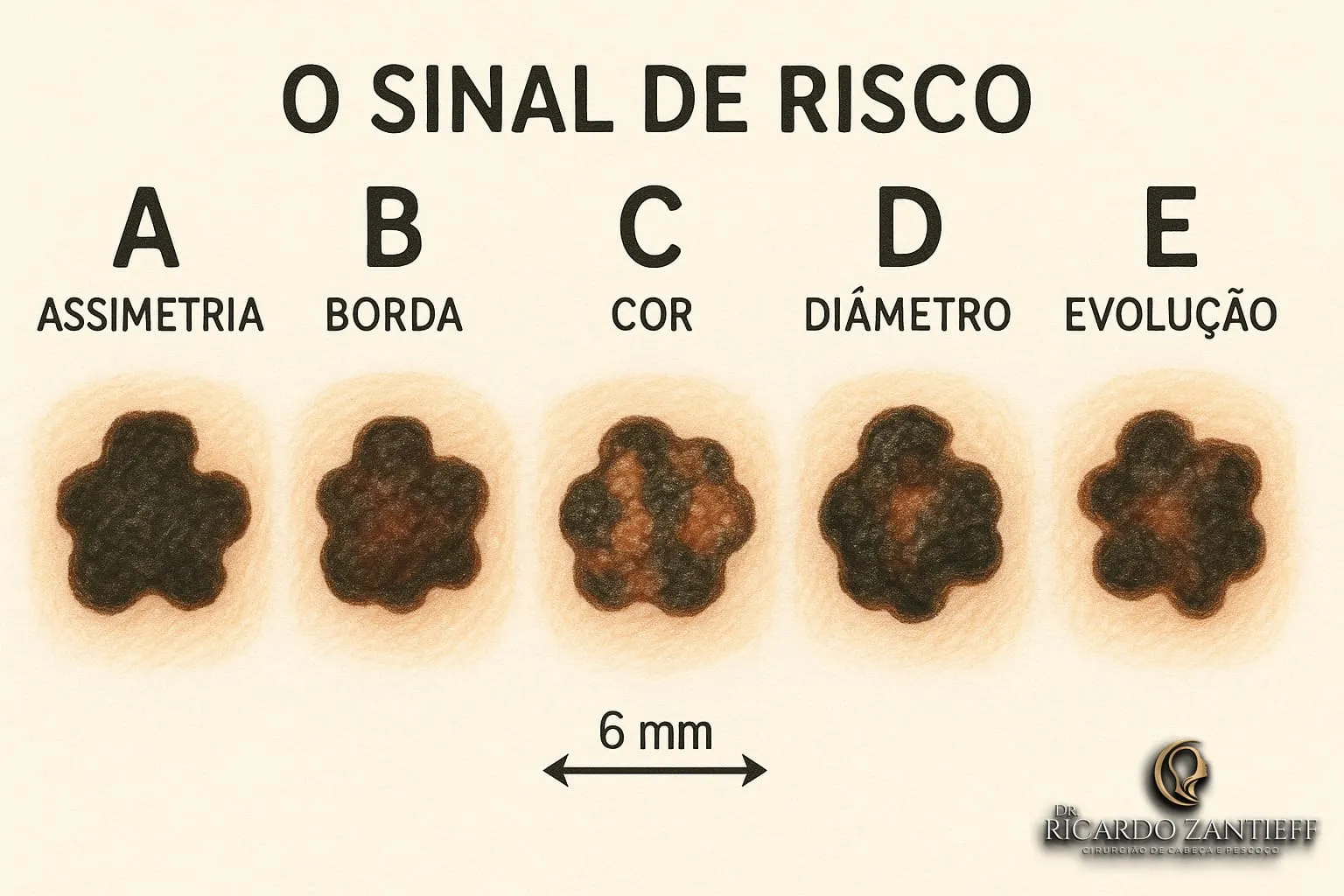 Imagem representando os sinais de riscos de câncer de pele